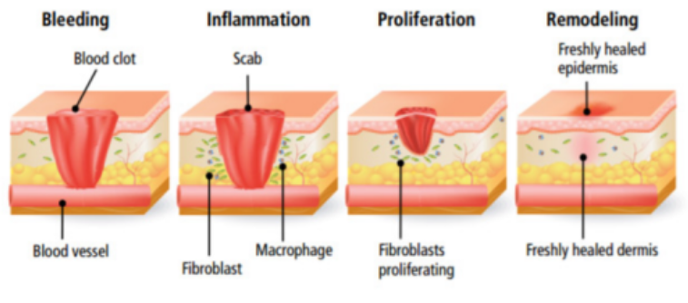 <p>hemostasis → inflammation → proliferation → remodeling </p>