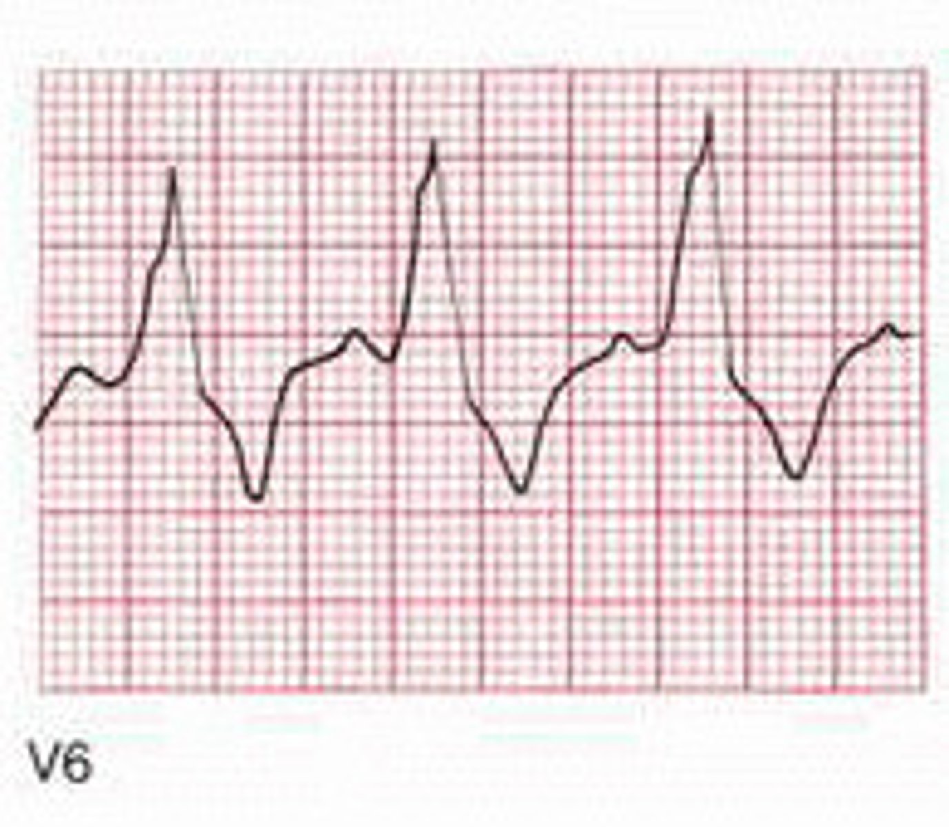 <p>- QRS abnormally wide </p><p>- QRS in V1 </p><p>- appropriate discordance (ST elevation in leads with negative QRS complexes) </p>
