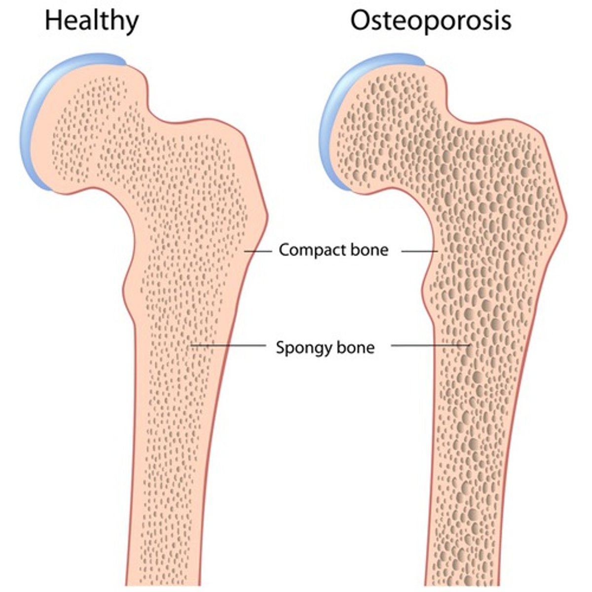 <p>______ is a chronic condition in which the bone slowly weakens and becomes prone to breaking.</p>