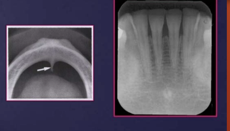 <p>as radio-opaque circles that surround the lingual foramen just below the apices of the incisors</p>