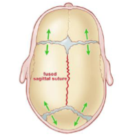 <p>Synostotic Sagittal vs Deformational Scaphocephaly </p>