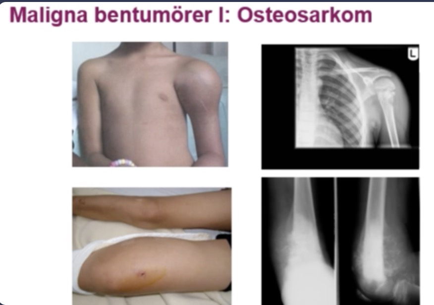 <p><br><span>En sällsynt form av bencancer där osteoblaster omvandlas till cancerceller</span></p><p></p>