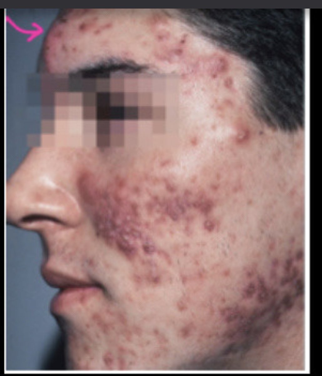 <p>Acne Vulgaris</p>