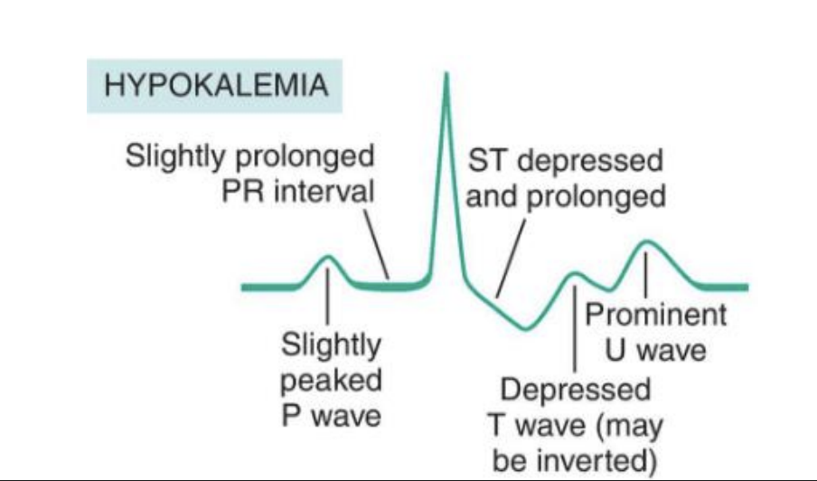 <p>muscle weakness, cramps</p><p>EKG (inverted/flattened T wave, prominent U wave) </p>