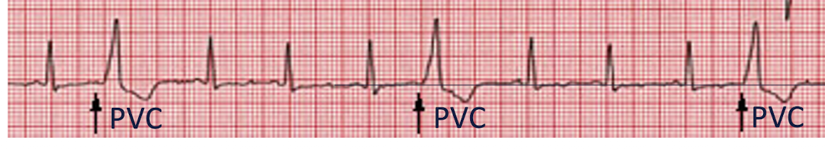 <p>Premature Ventricular Contracture (PVC):</p><ul><li><p>Heart beat initiated by:</p></li><li><p>Presentation: (2)</p></li><li><p>PVC that occur 3 or more in a row =</p></li></ul><p></p><p></p>