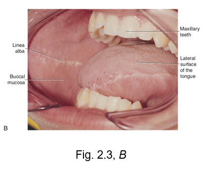 <ul><li><p>LINEa alba  - looks like a line</p></li><li><p>this is a white ridge of calloused tissue (hyperkeratinization) that extends horizontally at the level where the maxillary and mandibular teeth come together to occlude</p></li><li><p>can occur on the buccal mucosa or the lateral surface of tongue</p></li></ul><p></p>