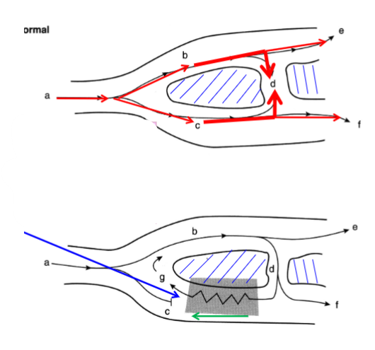 <p>In a normal heart at point d the 2 currents cancel each other out. In an injured heart, the conduction is interrupted.</p><p><span>Depolarisation passes back through injured area and area G is induced to depolarisation again but too early!</span></p><p><span>An ectopic beat can occur</span></p>