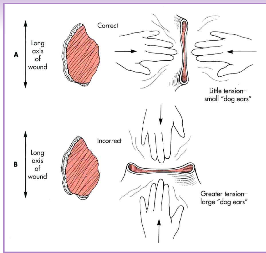 <ul><li><p>tension lines are formed by the predominant pull of fibrous tissue within the skin </p></li><li><p>tension increases the risk of closure complications </p></li><li><p>generally close skin <strong>parallel </strong>to tension lines </p></li><li><p>if closed perpendicular to skin tension lines: </p><ul><li><p>delays in healing </p></li><li><p>wider scar </p></li><li><p>more tension - dehiscence, pain </p></li><li><p>dog ears </p></li></ul></li></ul><p></p>