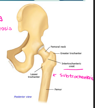 <p><strong>Hip Fractures: Background</strong></p><p>-Fracture Classification </p><ul><li><p>_______________ → femoral head or neck. Higher rate of nonunion and avascular necrosis. Rarely presents with swelling or bruising. </p></li><li><p>Extracapsular → _______________ (between the trochanters) and subtrochanteric </p></li></ul><p>-Mechanism of Injury</p><ul><li><p>Fall in _______ is the most common, while ______ in younger patients is another potential cause </p></li></ul><p></p>