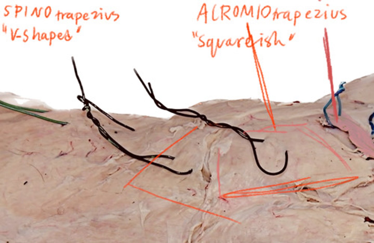 <p>Behind the Acromitrapezius</p>