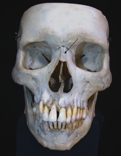 nasal bone 