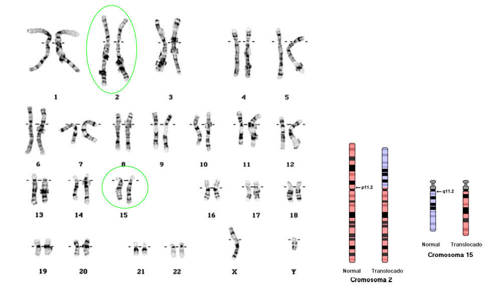 Quelle est l’anomalie associée à ce caryotype ? 