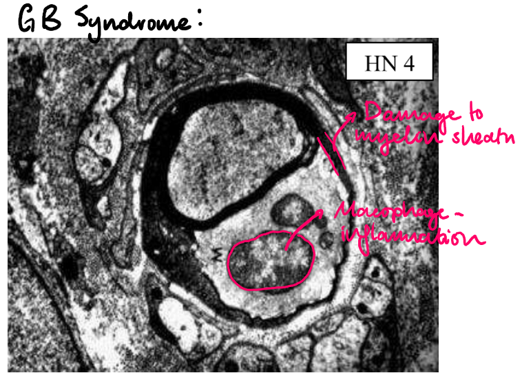 <p>Rapidly progressing, acute demyelinating disorder affecting peripheral motor axons</p><p><u>Pathogenesis:</u> humoral and T-cell mediated immune response and macrophage activation which attacks schwann cells and engulfs myeline sheath, causing segmental degeneraion</p><p><u>Causes:</u> Campylobacter infection, CMV, EBV, HIV, prior vaccinations</p><p><u>Signs:</u></p><ul><li><p>Weakness and paralysis starting in distal limbs</p></li><li><p>Advances proximally</p></li></ul><p><u>Treatment</u>:</p><ul><li><p>Paramapharesis</p></li><li><p>IV immunoglobulins and steroid therapy</p></li></ul><p></p>