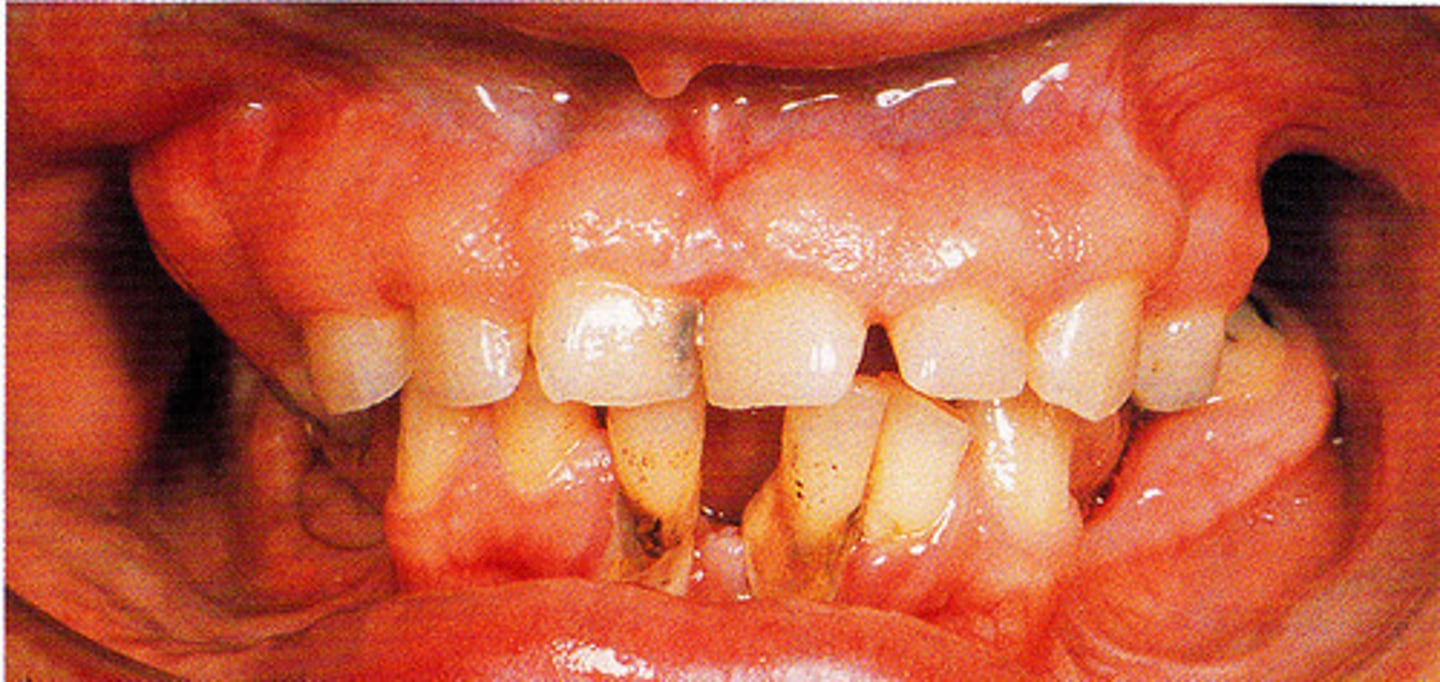 <p>Gingival Fibromatosis</p>