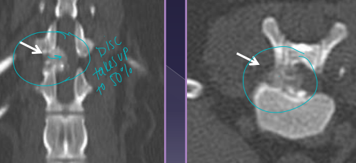 <ul><li><p><strong>Herniation (Hansen Type I)</strong><span style="color: red;"><strong> Acute → fast progressive</strong></span></p><ul><li><p><span style="color: rgb(136, 136, 136);"><strong>Et:</strong></span><strong> </strong><u>chondroid metaplasia</u>, <strong><u>increased intradisc pressure</u></strong></p></li><li><p><span style="color: rgb(136, 136, 136);"><strong>Sig:</strong></span> chondrodystrophics, 3-5y (TL) T10/11-L6/7 <u>¾ dogs</u></p><ul><li><p> 8-12y C2/3-C5/6 (Cervical) <u>¼ dogs</u></p></li></ul></li></ul></li><li><p><span style="color: rgb(136, 136, 136);"><strong>Cs:</strong></span><strong> Compressive myelopathy, Contusion injury</strong></p><ul><li><p>paraspinal hyperesthesia, hunched back, vocalization(cervical), forelimb lameness, ataxia/paresis, plegia</p></li></ul></li></ul><img src="https://knowt-user-attachments.s3.amazonaws.com/c739df3e-735b-4349-8a22-ecaa6222347b.png" data-width="50%" data-align="center"><ul><li><p><span style="color: rgb(136, 136, 136);"><strong>Dt: </strong></span><strong><u>CT/MRI (#1)</u></strong>, Rads(r/o) (narrowing, wedging, <strong><u>mineralized disc in SITU</u></strong>)</p></li><li><p><span style="color: rgb(136, 136, 136);"><strong>Tx:</strong> </span>percutaneous laser disc ablation(prevent T10/11-L5/6),<span style="color: red;"> <u>>4w rest</u></span>, NSAID, gabapentin, amantadine, v<span style="color: red;"><u>entral slot Sx (C), Hemilaminectomy (TL) </u></span></p><ul><li><p><u>Reoccurrenc</u>e: 15-20%, increased w/ >5 mineral disks </p></li></ul></li></ul><img src="https://knowt-user-attachments.s3.amazonaws.com/793ee256-4609-436d-af90-5cfe703ab615.png" data-width="50%" data-align="center"><ul><li><p><strong>Protrusion (Hansen Type II) </strong><span style="color: red;"><strong>Chronic → slow progressive</strong></span></p><ul><li><p><span style="color: rgb(136, 136, 136);"><strong>Et:</strong></span><strong> </strong>fibroid metaplasia,  <u>dorsal annulus weakens, nucleus bulges, </u><strong><u>TL </u></strong><u>> cervical</u></p></li><li><p><span style="color: rgb(136, 136, 136);"><strong>Sig:</strong></span><strong> Lg, non-chondrodystrophic, 5-12y older dogs</strong></p></li><li><p><span style="color: rgb(136, 136, 136);"><strong>Cs:</strong></span> <u>slow progressive ataxia</u>, <strong>pain at lesion</strong>, paresis</p></li><li><p><span style="color: rgb(136, 136, 136);"><strong>Dt:</strong></span><strong> <u>MRI</u></strong></p></li><li><p><span style="color: rgb(136, 136, 136);"><strong>Tx</strong></span><strong>: Medical(best): </strong>NSAID, gabapentin, <strong>SX</strong>: dorsal laminectomy → <span style="color: red;"><strong><u>decompression #1 goal</u></strong></span></p></li></ul></li></ul><img src="https://knowt-user-attachments.s3.amazonaws.com/68737a09-aa68-4187-8728-c9d3786e7a24.png" data-width="25%" data-align="center"><p></p>