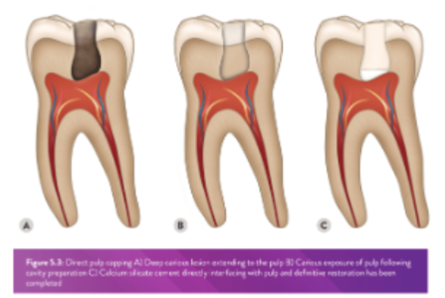 <p>- Dentine is lost due to caries, trauma or a prev iatrogenic intervention &amp; a cavity exists</p><p>- However, in this case the soft tissue of the pulp is exposed &amp; in most cases is bleeding</p><p>- If symptoms exist they should be relatively mild &amp; not considered to be indicative of IP</p>