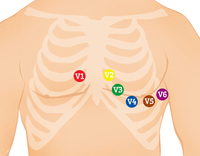 <p>V1: Right 4th intercostal space, next to the sternum.</p><p>V2: Left 4th intercostal space, next to the sternum.</p><p>V3: Midway between V2 and V4.</p><p>V4: Left 5th intercostal space, mid-clavicular line.</p><p>V5: Horizontal to V4, anterior axillary line.</p><p>V6: Horizontal to V5, mid-axillary line.</p>