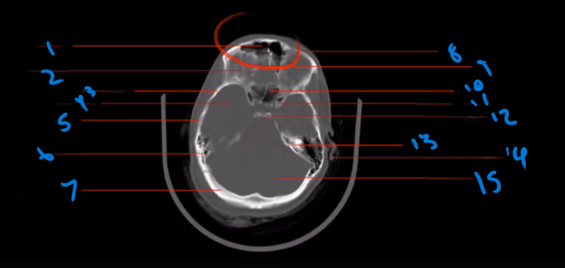 <p>Where the Sphenoid Sinus located?</p>