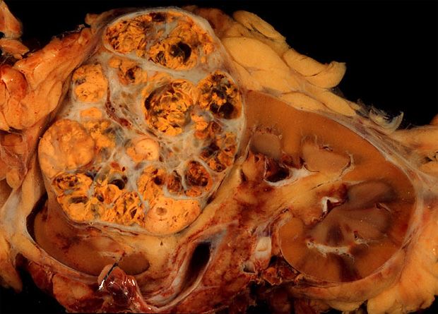 Often golden-yellow due to increase lipid content.