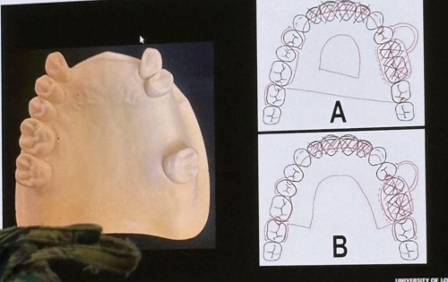 <p>-class iii mod i</p><p>-a have incomplete clasp assemblies</p><p>-b is acceptable for patients with esthetic concerns</p>