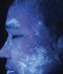 <p>Ultraviolet light used to highlight areas of abnormal skin; light makes vitiligo appear bright white and tinea  \n capitis appear blue-green.</p>