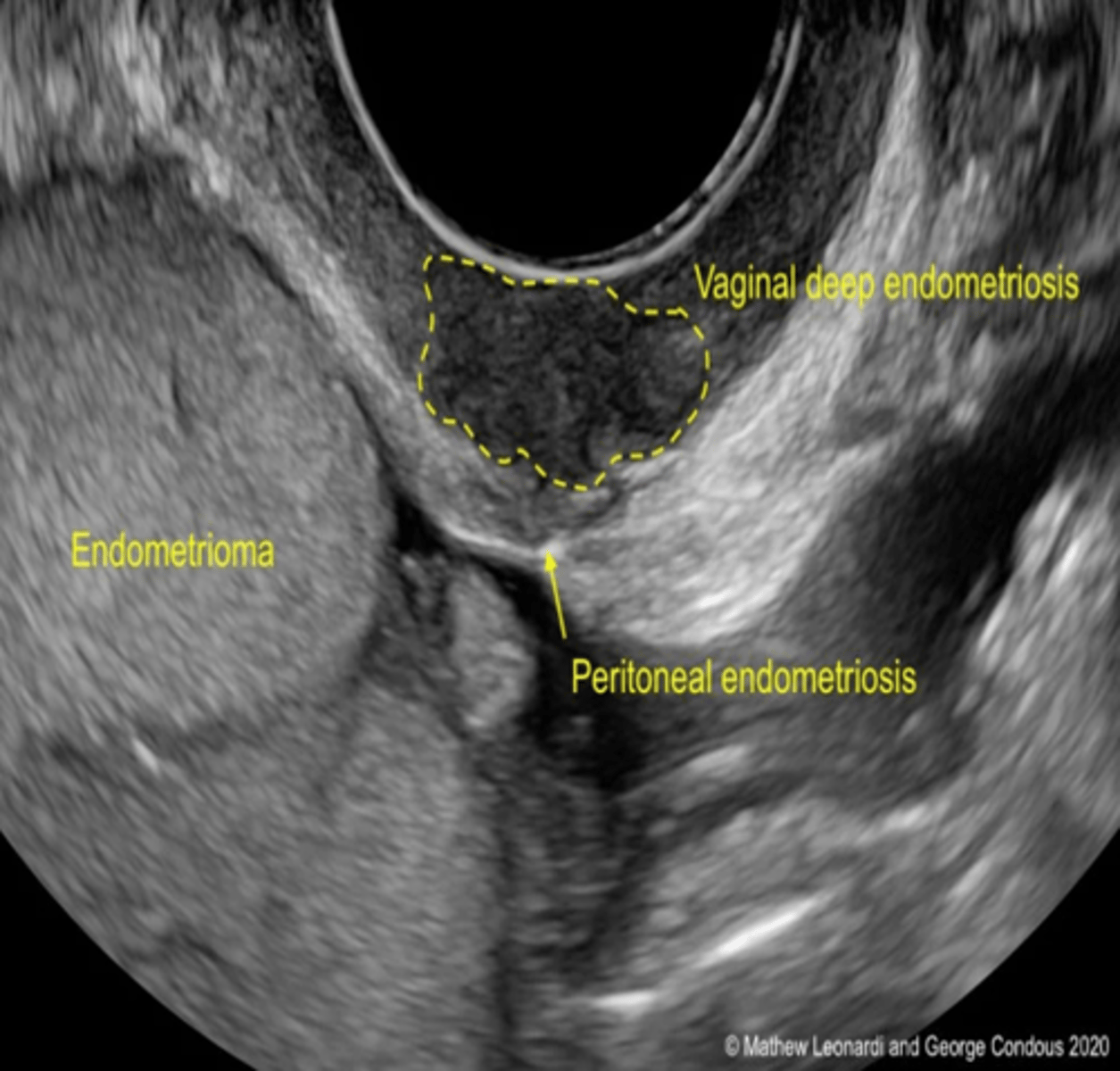 <p>endometrioma; chocolate cyst</p>