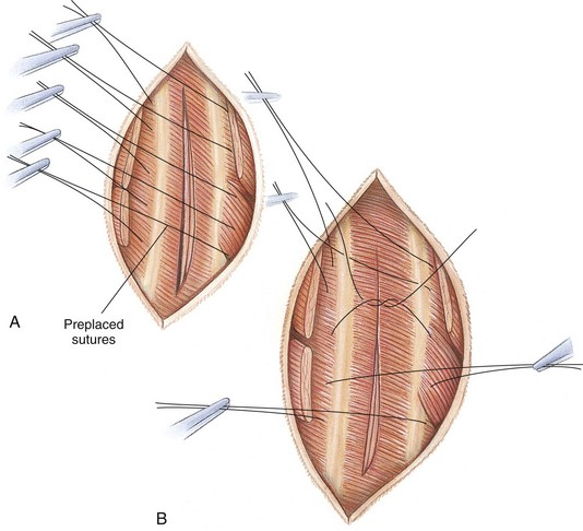 <p>Preplace 4-8 sutures around two ribs either side of the incision, criss-cross arrangement for easy organisation of sutures, tied during inspiration. Start from centre suture.</p>