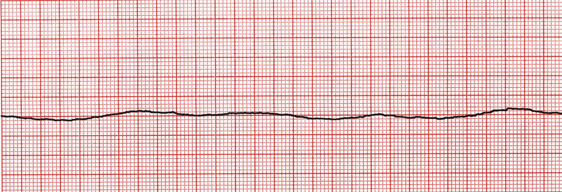 <ul><li><p>colloquially referred to as  a flatline</p></li><li><p>complete cessation of electrical and mechanical activity in the heart </p></li></ul><p></p>