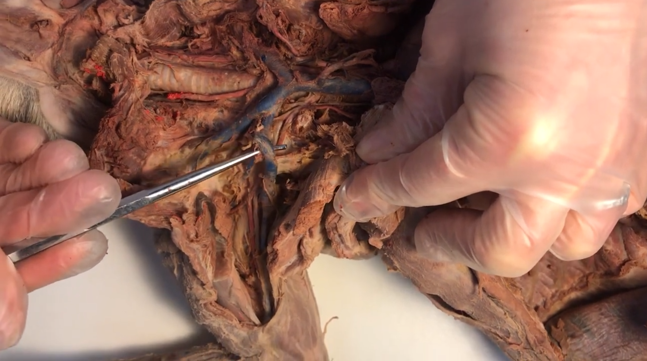 <p>What vein is this</p>