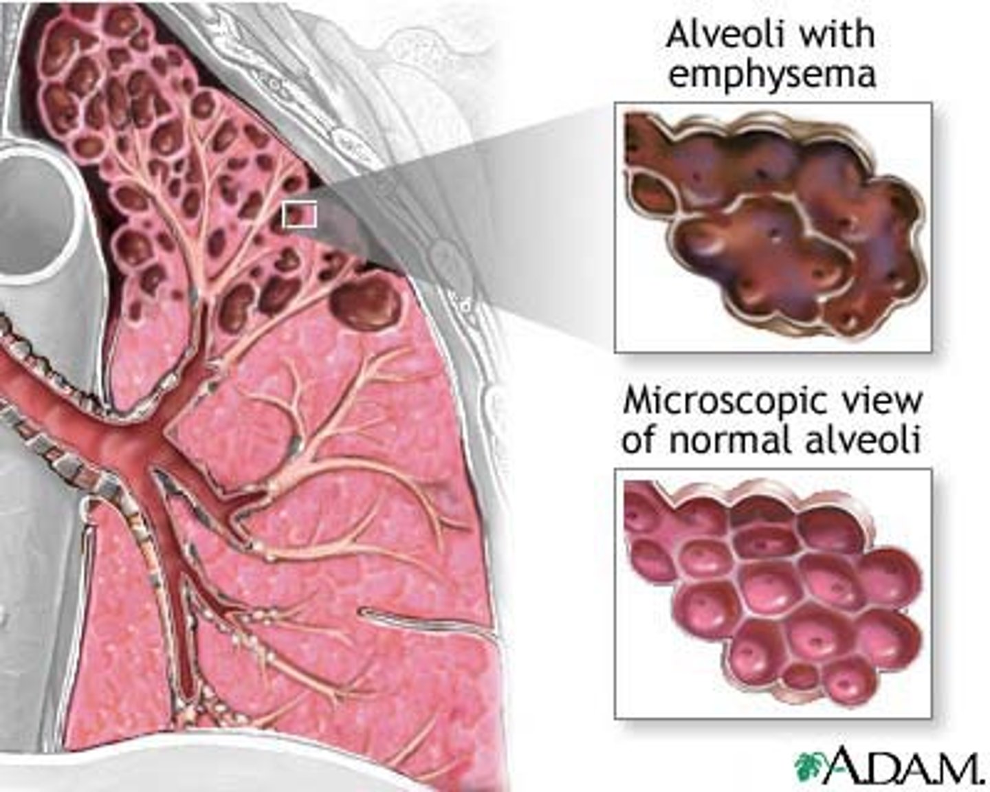 <p>DEFINITION</p><p>reduces surface area of alveoli by scaring them - caused by smoking</p>