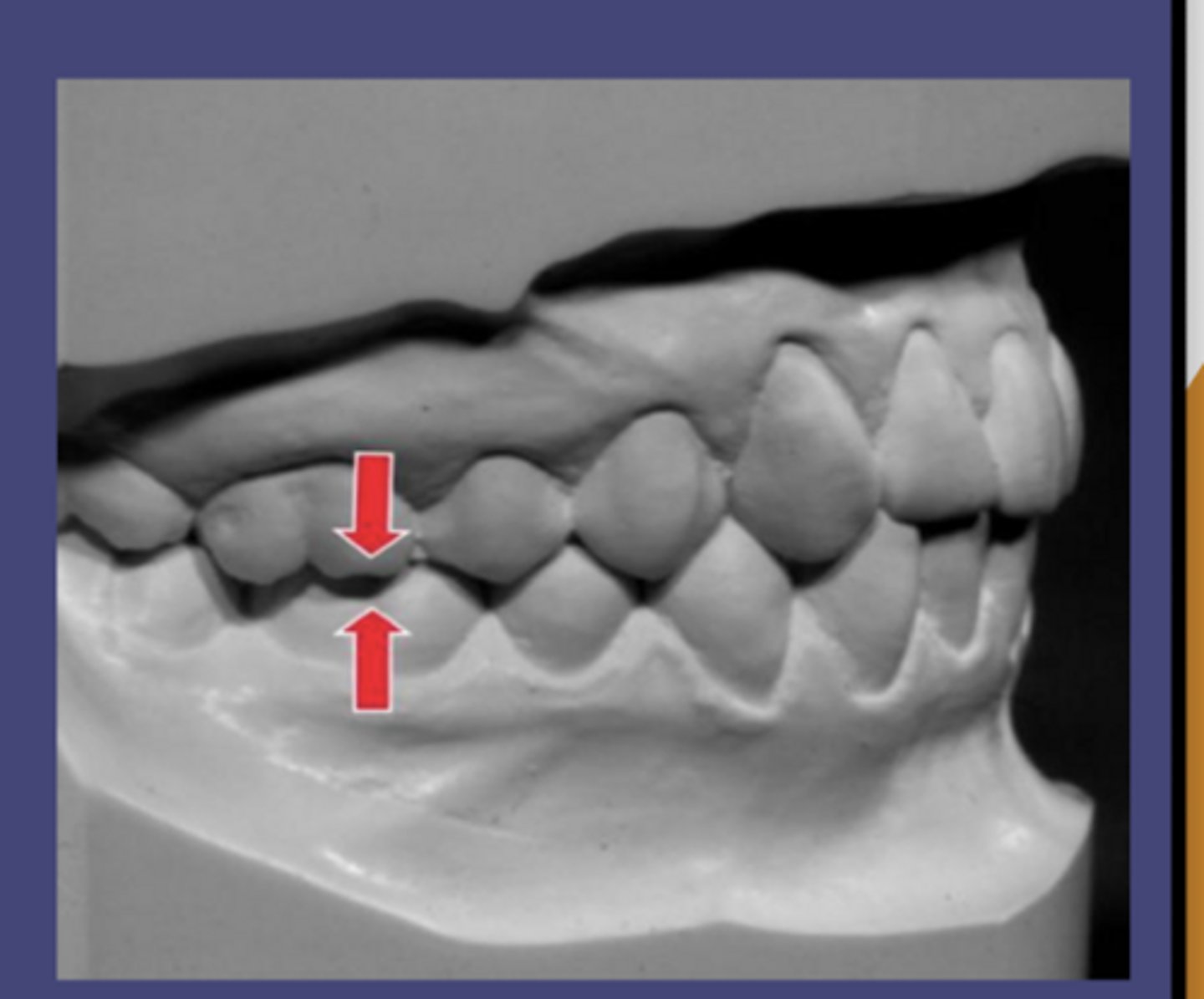 <p>maxillary; mandibular</p>