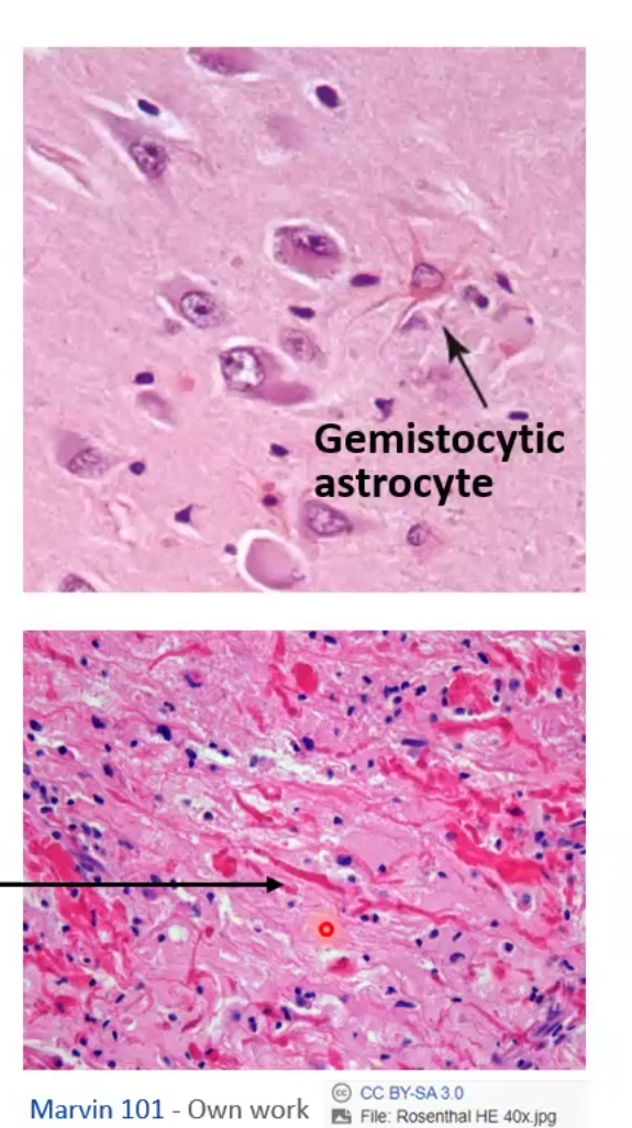 <p>Reactions of Astrocytes to Injury</p><ul><li><p>Gemistocytic astrocytes: swollen eosinophilic cytoplasm with branching processes</p></li><li><p>Astrogliosis: abnormal increase in the number of astrocytes</p></li><li><p>Chronic Gliosis: may have protein aggregates presenting as “rosenthal fibers”</p><p></p><p>Reactions of Microglial Cells to Injury</p><ul><li><p>Proliferation, Elongated nuclei, cell aggregates</p><p></p><p>Reactions of Oligodendrocytes and ependymal Cells to Injury</p></li><li><p>LImited</p></li></ul></li></ul><p></p>