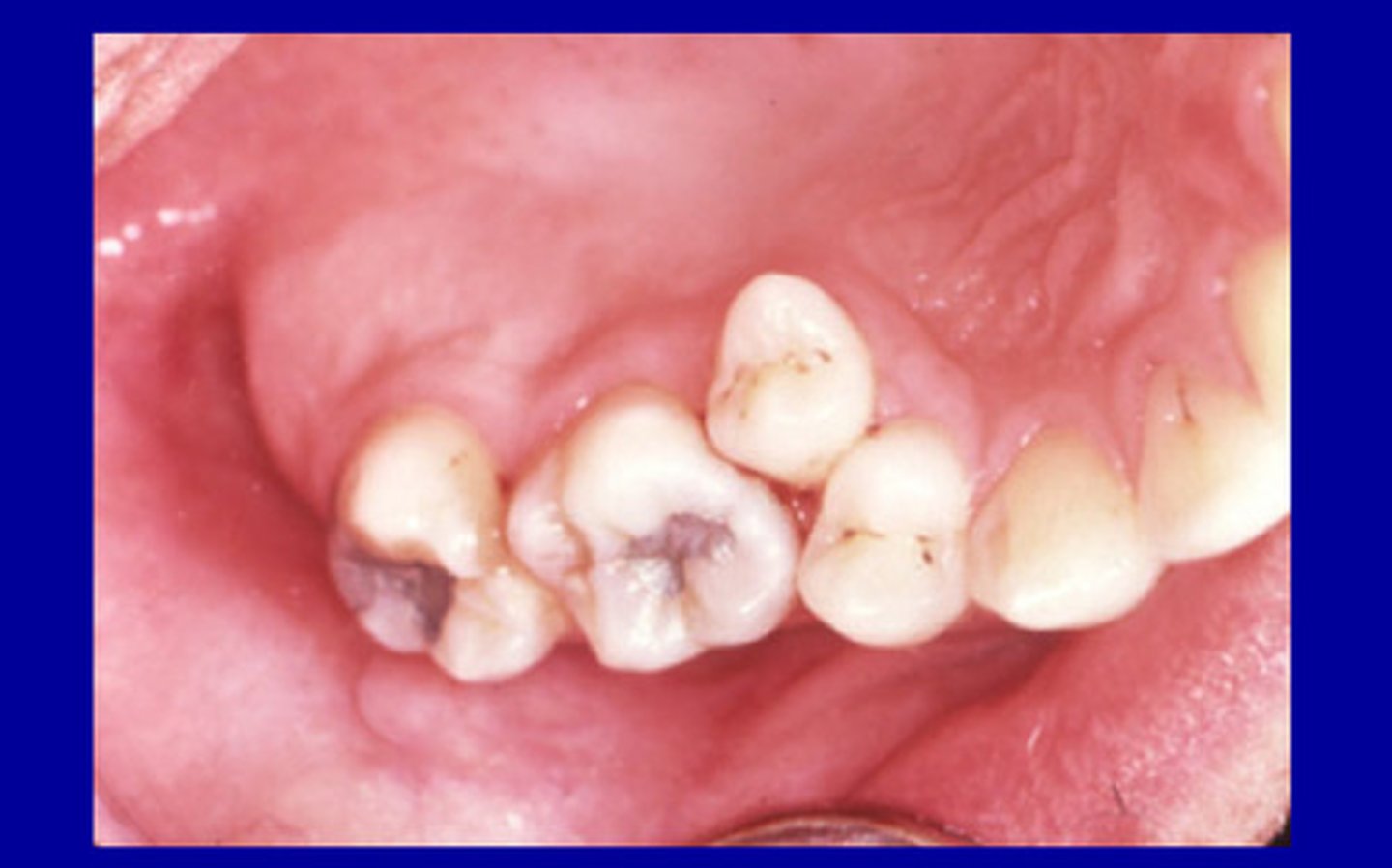 <p>• Crowding</p><p>• Tipping</p><p>• Root proximity</p>