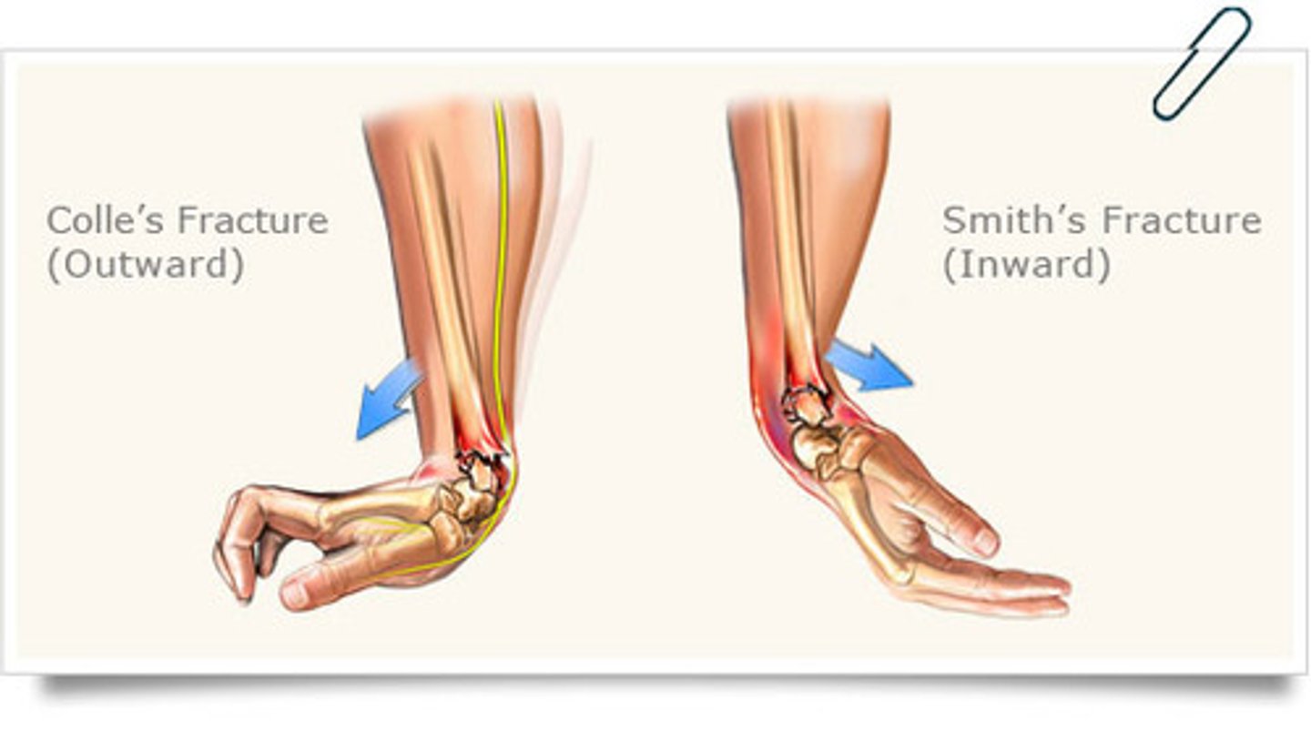 <p>Smith's Fracture: radius dislocates in volar direction (garden spade deformity)</p><p>Colle's Fracture: radius dislocations in dorsal direction (dinner fork deformity)</p>