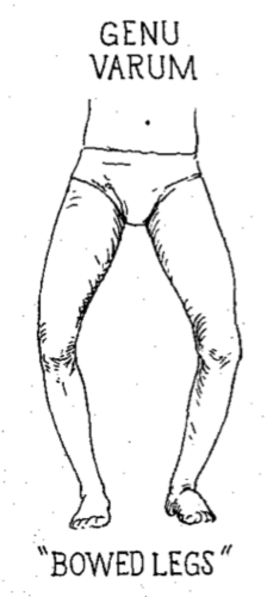 <p>Bow-legged</p>