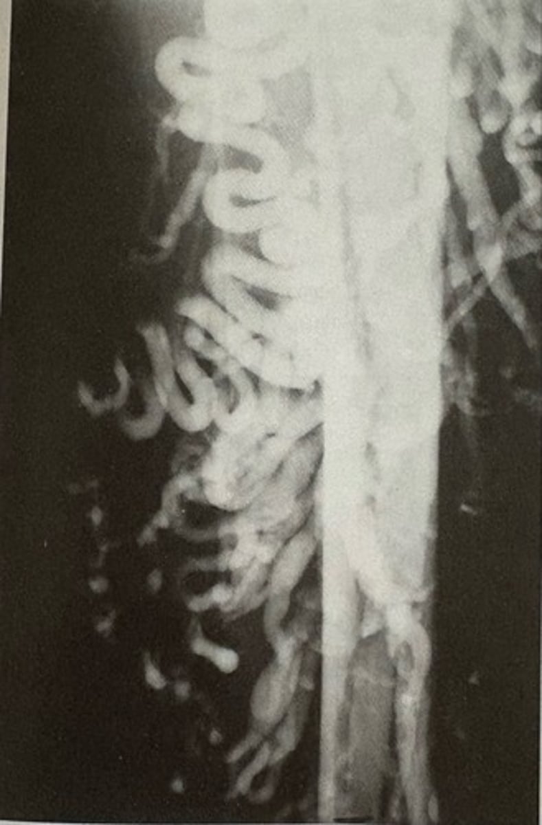 <p>what pathology is present?</p>