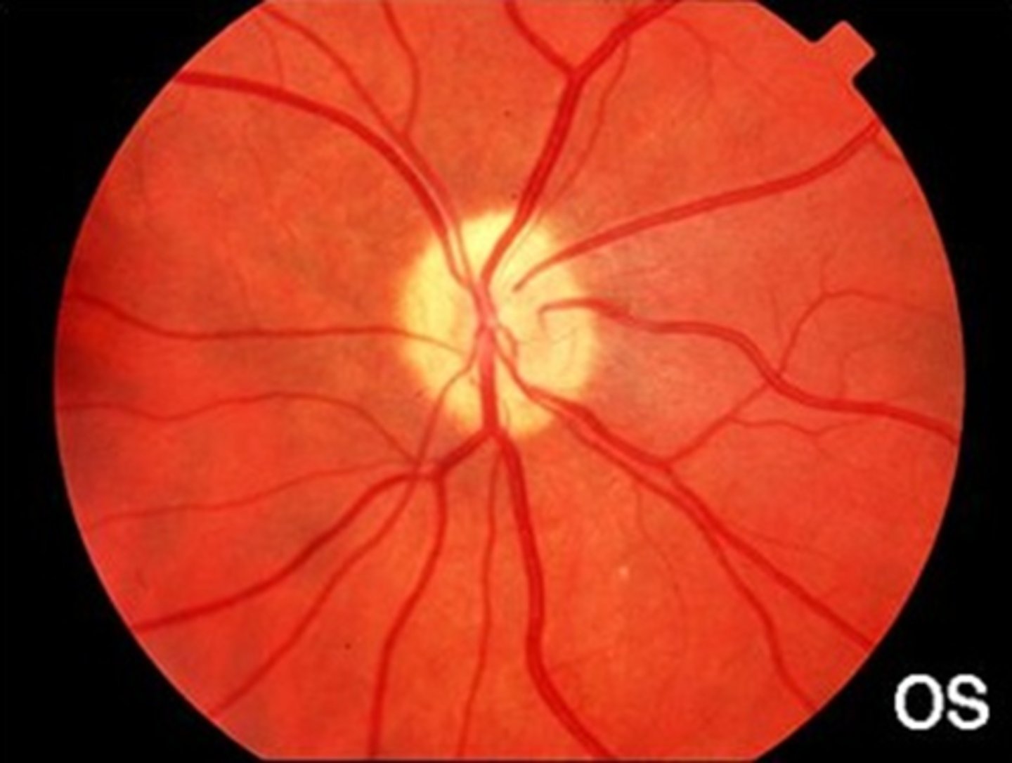 <p>hypoplastic ONH = part of sclera is filling optic canal around the ONH</p>