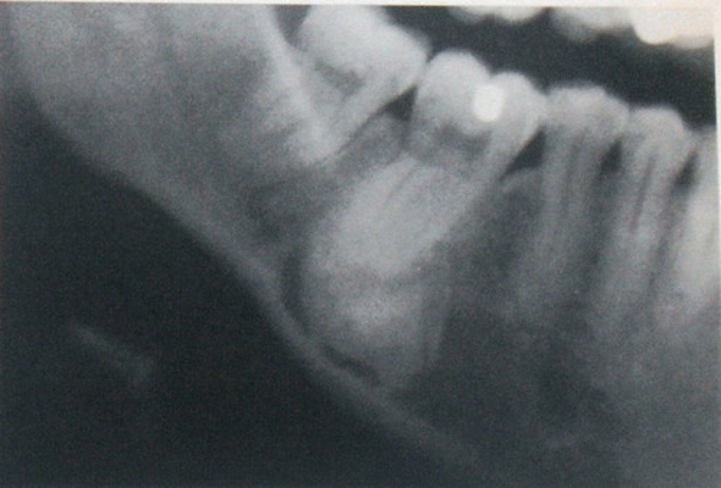 <p>asymptomatic, radiopaque, unknown origin, no inflam./dysp./neop. etiologies</p>