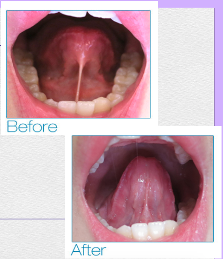 <p><strong>aka:</strong> tongue-tie</p><p>a condition in which the<span style="color: red;"><span> lingual frenum is attached too far anteriorly</span></span> toward the tip of the tongue</p><p><span style="color: red;">prevents the tip of the tongue from reaching the hard palate</span> when the mouth is open</p><ul><li><p><strong>effects:</strong></p><ul><li><p><span style="color: red;"><span>aberration</span></span> in speech</p></li><li><p>depending on the severity of the condition</p></li></ul></li></ul><ul><li><p><strong>management:</strong></p><ul><li><p>s<span style="color: red;"><span>urgical correction</span></span> when causes speech, swallowing, or other functional problems</p></li></ul></li></ul><p></p>
