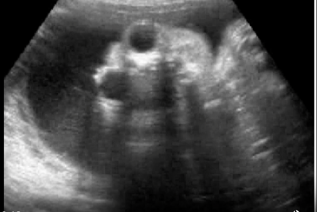 <p>what maternal serum level will be increased</p><p>.</p><p>this is frog eyes aka anencephaly</p><p>.</p><p>a) inhibin A</p><p>b) estriol</p><p>c) delta OD450</p><p>d) AFP</p>