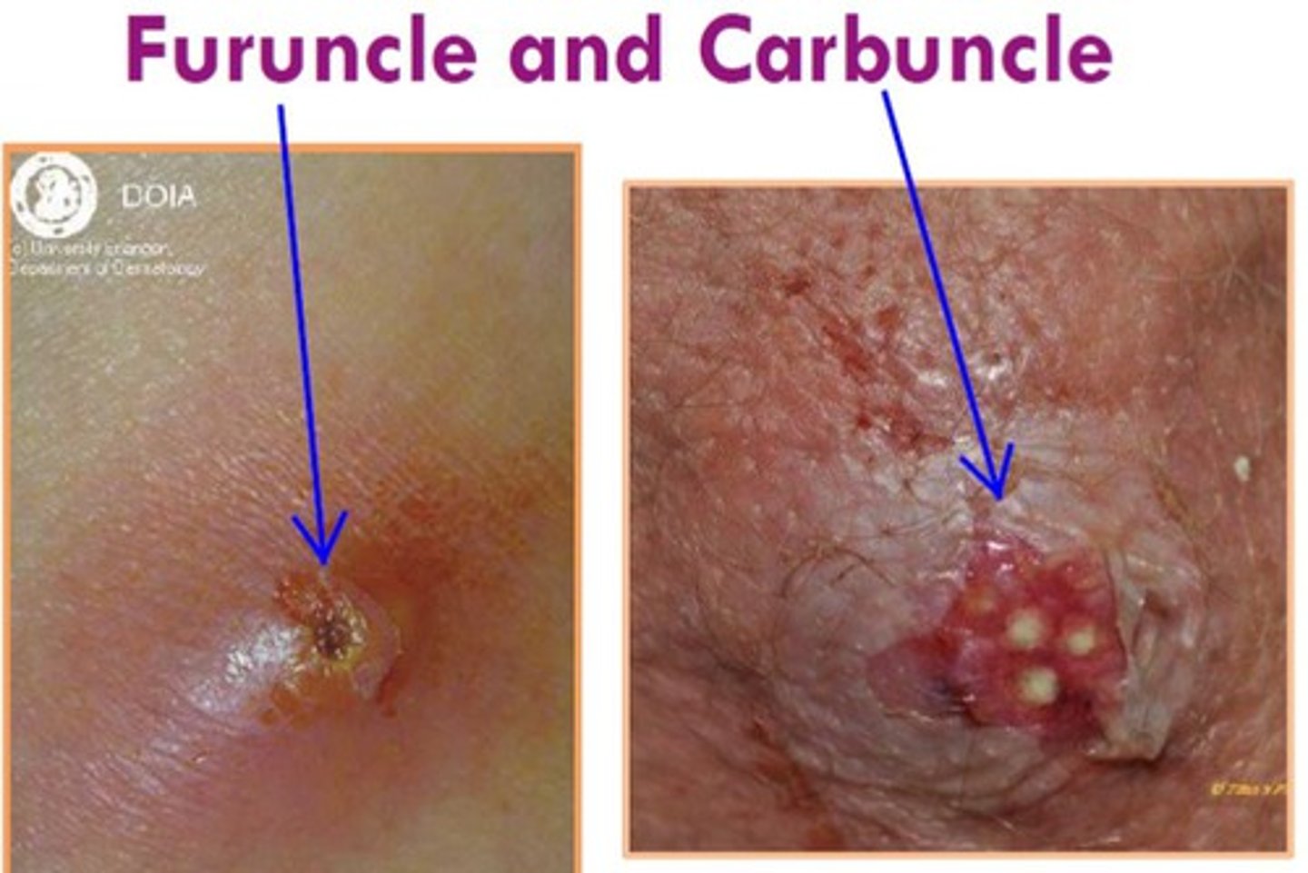 <p>bacterial infection of skin and subcutaneous tissue composed of a cluster of boils (furuncles, see below) caused by staphylococcal bacteria</p>
