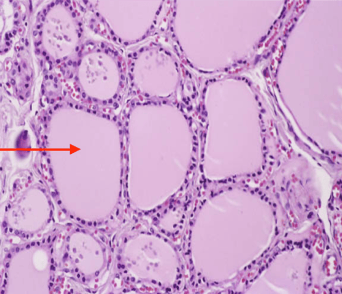 <p>a mixture consisting of tiny particles that are intermediate in size between those in solutions and those in suspensions and that are suspended in a liquid, solid, or gas</p>