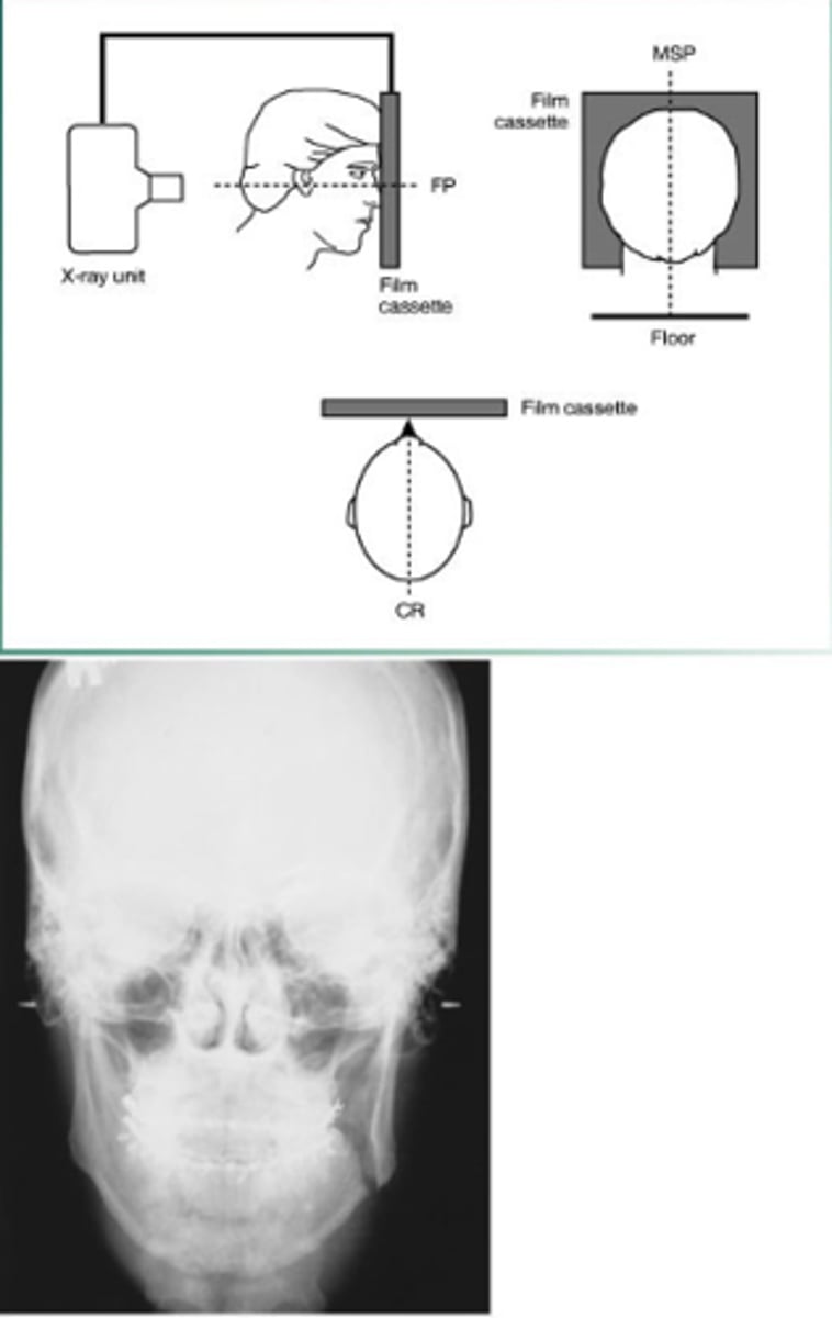 <p>evaluate facial growth and development, trauma, disease and developmental abnormalities; shows sinuses, nasal cavity, and orbits</p>