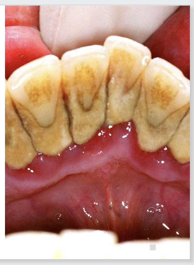 <p><span style="font-size: calc(var(--scale-factor)*18.02px);"><span>After a variable time, the MATURE PLAQUE CAN MINERALIZE and form</span></span><span><span><br></span></span><span style="font-size: calc(var(--scale-factor)*18.02px);"><span>calculus, tartar or scale.</span></span><span><span><br></span></span><span style="font-size: calc(var(--scale-factor)*18.02px);"><span>Its microbial composition is usually very similar to the mature plaque, at</span></span><span><span><br></span></span><span style="font-size: calc(var(--scale-factor)*18.02px);"><span>least in its qualitative aspects, although it has fewer number of viable cells.</span></span></p><p><span><span><br></span></span><span style="font-size: calc(var(--scale-factor)*18.02px);"><span>Tartar is constituted by 70-80% of inorganic salts and the rest of</span></span><span><span><br></span></span><span style="font-size: calc(var(--scale-factor)*18.02px);"><span>proteins, carbohydrates and small amounts of lipids.</span></span></p><p><span><span><br></span></span><span style="font-size: calc(var(--scale-factor)*18.02px);"><span>The four most common inorganic components are hydroxyapatite,</span></span><span><span><br></span></span><span style="font-size: calc(var(--scale-factor)*18.02px);"><span>whitlockite, phosphate octocalcium and brushite.</span></span></p><p><span><span><br></span></span><span style="font-size: calc(var(--scale-factor)*18.02px);"><span>Regarding to its genesis, various theories have been proposed:</span></span><span><span><br></span></span><span style="font-size: calc(var(--scale-factor)*18.02px);"><span>1. Oversaturation of salts in saliva and in the matrix.</span></span><span><span><br></span></span><span style="font-size: calc(var(--scale-factor)*18.02px);"><span>2. Pyrophosphate-pyrophosphatase system in the matrix.</span></span><span><span><br></span></span><span style="font-size: calc(var(--scale-factor)*18.02px);"><span>3. Deregulation of the mineralization process.</span></span><span><span><br></span></span><span style="font-size: calc(var(--scale-factor)*18.02px);"><span>4. Intracellular crystallization.</span></span><span><span><br></span></span><span style="font-size: calc(var(--scale-factor)*18.02px);"><span>On the constituted calculus a new AF can develop and restart all the</span></span><span><span><br></span></span><span style="font-size: calc(var(--scale-factor)*18.02px);"><span>process indicated previously. </span></span></p>