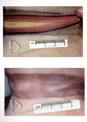 <p>post mortem insect bites can mimic</p>
