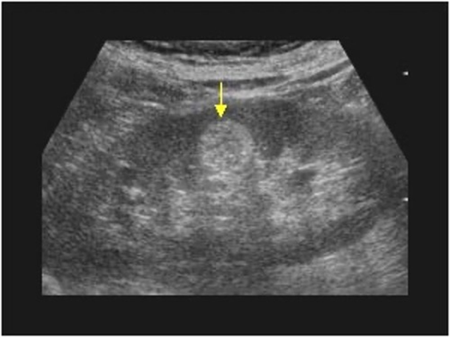 <p>Renal angiomyolipoma (AML) is composed of ___, ___, and ___ </p>