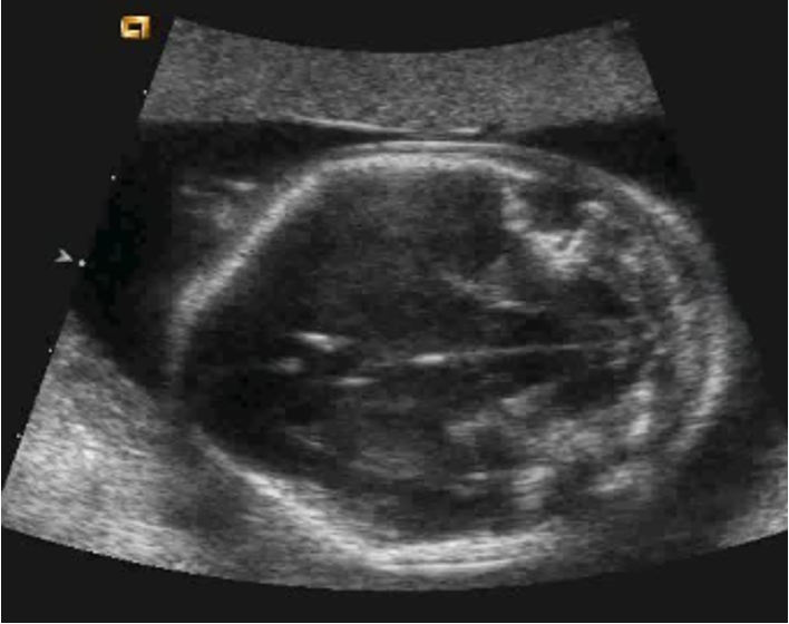 <p>flattening of cerebellum against occipital bone in cases of spina bifida/ encephalocele (banana on very right side) </p>