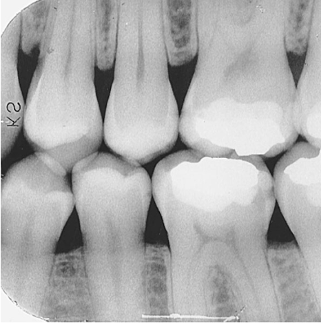 <p>The crowns of maxillary and mandibular teeth, the interproximal areas, and the crestal bone — all on the same image.</p>