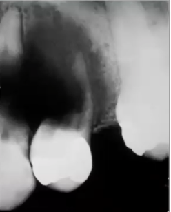 <p>ill defined<strong> MOTH EATEN</strong> appearance, and widening of PDL space</p>
