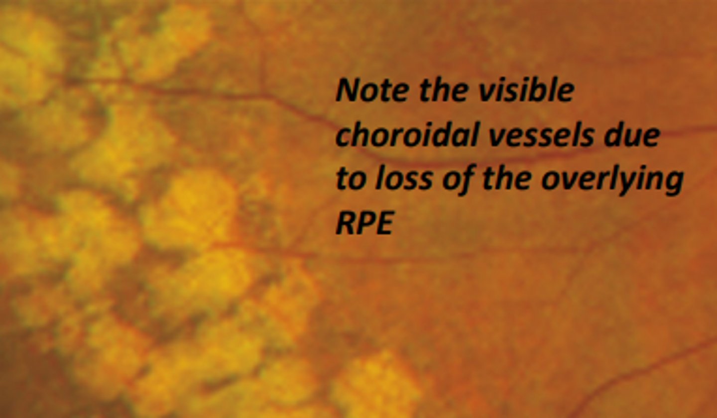 <p>outer retina and chorioretinal degeneration resulting from occlusion of compartments of the choriocapillaris. Is usually bilateral, asymmetrical, and inferior occurring between the equator and ora. Is associated with increasing age (above 40) and is generally benign with no increased risk of retinal breaks.</p>